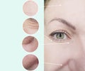 Eyes of a woman wrinkles lifting  removal  before and after, procedures Royalty Free Stock Photo