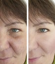 Face  couperose of an elderly woman face wrinkles before and after procedures Royalty Free Stock Photo