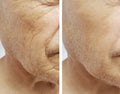 Face elderly man patient forehead wrinkles medicine therapy face before and after procedures Royalty Free Stock Photo