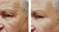 Face elderly man patient forehead wrinkles therapy face before and after procedures Royalty Free Stock Photo