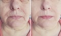 Face  couperose of an elderly aging  woman face  treatment wrinkles before and after procedures Royalty Free Stock Photo