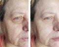 Face couperose of an elderly aging face treatment wrinkles before and after procedures Royalty Free Stock Photo