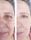 Face  couperose of an elderly aging    patient face  treatment wrinkles before and after procedures Royalty Free Stock Photo