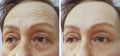 Face elderly woman forehead wrinkles before and after cosmetic procedures