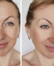 Face elderly woman wrinkles before and after cosmetic procedures collagen Royalty Free Stock Photo