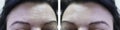 Face elderly woman forehead wrinkles before and after cosmetic procedures collagen