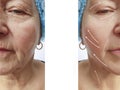 Face elderly woman patient wrinkles contrast removal on the face before and after procedures, swollen Royalty Free Stock Photo