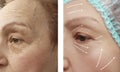 Face of an elderly woman patient wrinkles filler collagen contrast removal on the face before and after procedures, swollen Royalty Free Stock Photo