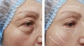 Face elderly woman patient wrinkles removal health on the face before and after procedures, swollen Royalty Free Stock Photo