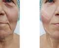 Face of an elderly woman patient wrinkles treatm collagen contrast removal on the face before and after procedures, swollen Royalty Free Stock Photo