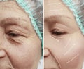 Face of an elderly woman regeneration patient wrinkles contrast removal on the face before and after procedures, arrowswollen Royalty Free Stock Photo