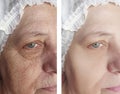 Face of an elderly woman removal wrinkles beautician lifting therapy before and after procedures Royalty Free Stock Photo