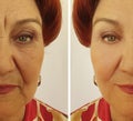 Face of an elderly woman removal wrinkles difference result regeneration hydrating mature before and after treatment Royalty Free Stock Photo