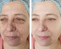 Face of an elderly woman removal wrinkles lifting therapy before and after procedures Royalty Free Stock Photo