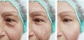 Face of an elderly woman patient wrinkles contrast removal on the face before and after procedures, arrowswollen Royalty Free Stock Photo