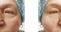 Face of an elderly woman patient wrinkles contrast removal on the face before and after procedures, swollen Royalty Free Stock Photo