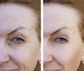 Face of an elderly surgery woman wrinkles dermatology treatment face collagen ,before and after procedures Royalty Free Stock Photo