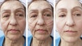 Face, elderly woman, wrinkles, health filler patient contrast correction before and after procedures, arrow Royalty Free Stock Photo