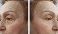Face of an elderly woman wrinkles dermatology procedure before and aftetherapy r