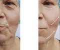 Face of an elderly woman patient wrinkles collagen contrast removal on the face before and after procedures, arrowswollen Royalty Free Stock Photo