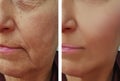 Face of an elderly woman wrinkles hydrating treatment collagen removal dermatology before and after procedures Royalty Free Stock Photo