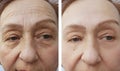 Face of an elderly woman wrinkles before and after procedures