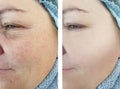 Face   elderly woman correction removal wrinkles beautician lifting therapy before and after procedures Royalty Free Stock Photo