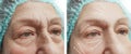 Face of an elderly woman with wrinkles removal on the face before and after procedures, arrow Royalty Free Stock Photo