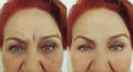 Face eye of an elderly result woman removal wrinkles difference result regeneration hydrating mature before and after treatment Royalty Free Stock Photo