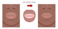 Face front_African American Upper and Lower Lips reduction
