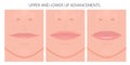 Face front_Upper and Lower Lip Advancements