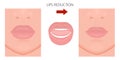 Face front_Upper and Lower Lips reduction