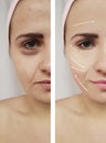 Face girl eyes wrinkles swollen biorevitalization before and after difference procedures Royalty Free Stock Photo