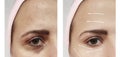 Face girl eyes wrinkles before and after difference procedures Royalty Free Stock Photo
