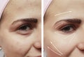 Face girl eyes wrinkles swollen biorevitalization regeneration before and after difference procedures Royalty Free Stock Photo