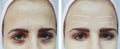 Face girl eyes wrinkles swollen before and after difference procedures Royalty Free Stock Photo