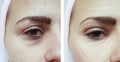 Face girl eyes wrinkles swollen regeneration before and after difference procedures