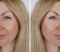 Face girl wrinkle before and after correction cosmetic procedures