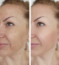 Face girl wrinkle before and after lifting correction cosmetic procedures Royalty Free Stock Photo