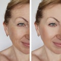 Face girl wrinkle before and after treatment correction cosmetic procedures