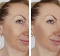 Face girl wrinkle before and after effect correction cosmetic procedures Royalty Free Stock Photo