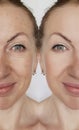 Face girl wrinkle before and after effect lifting correction cosmetic procedures Royalty Free Stock Photo