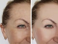 Face girl wrinkles before and after correction rejuvenation cosmetic procedures Royalty Free Stock Photo