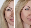 Face girl wrinkles before and after cosmetic therapy procedures Royalty Free Stock Photo