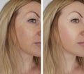 Face girl wrinkles before and after cosmetic procedures Royalty Free Stock Photo