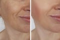 Face girl wrinkles before and after lifting facial procedures Royalty Free Stock Photo
