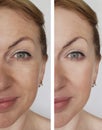 Face girl wrinkles before and after lifting rejuvenation cosmetic procedures Royalty Free Stock Photo