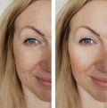 Face girl wrinkles before and after lift results lifting facial procedures Royalty Free Stock Photo