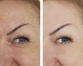 Face girl wrinkles before and after lifting facial cosmetic procedures
