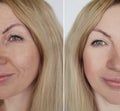 Face girl wrinkles before and after results lifting facial procedures Royalty Free Stock Photo